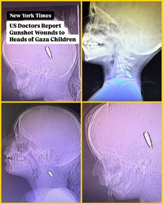 پزشکان آمریکایی: سربازان اسرائیل به سر کودکان غزه شلیک می‌کنند +عکس
