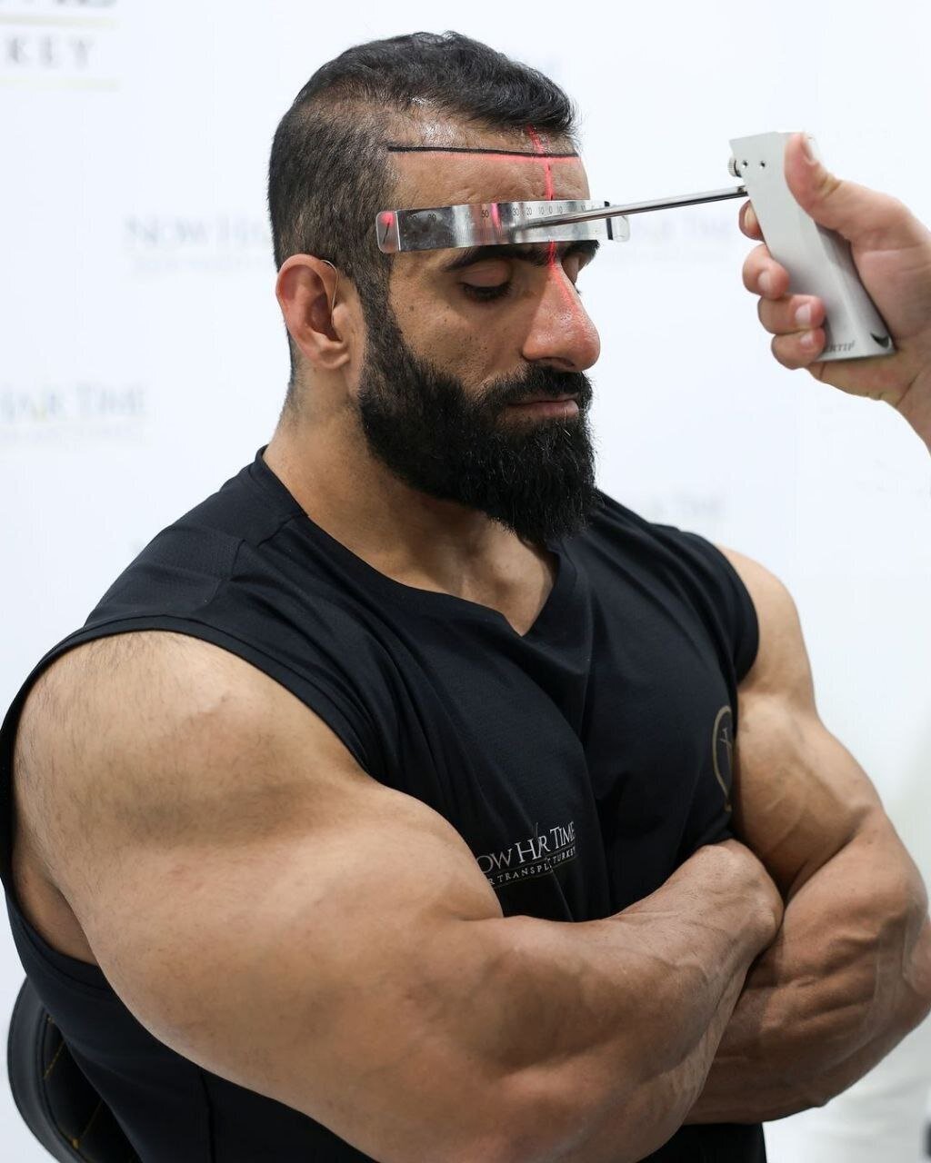 عکسهای هادی چوپان پس از کاشت مو خبرساز شد