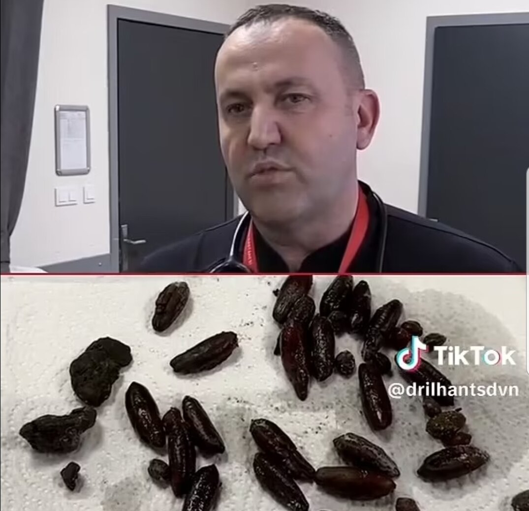 تصاویر هولناک بیرون‌آوردن ۷۰ هسته زیتون و خرما از شکم این زن را ببینید!