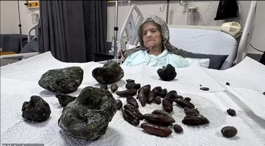تصاویر هولناک بیرونآوردن ۷۰ هسته زیتون و خرما از شکم این زن را ببینید!