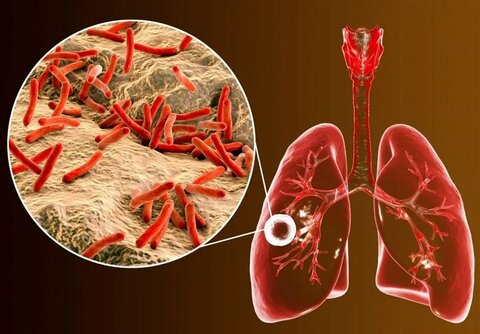 شیوع یک بیماری خطرناک در ایران؛ چند درصد از مبتلایان اتباع هستند؟