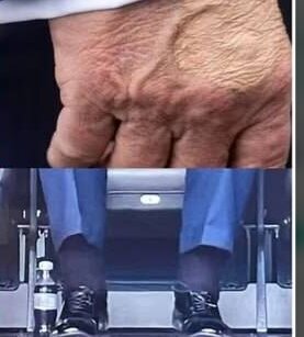 ماجرای کامل بیماری دونالد ترامپ/ مریضی رئیسجمهور آمریکا خطرناک است؟ +عکس