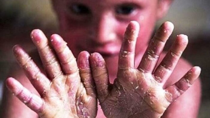 درد و رنج این بیماران زیر پوست تحریم پایانی ندارد