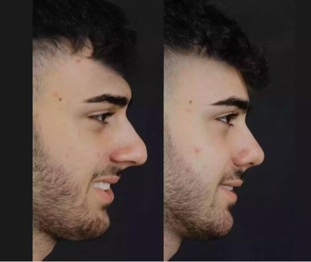 جراحی بینی چیست؟ بررسی هزینه‌ها و مراحل انجام عمل بینی