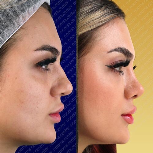 قبل و بعد از جراحی زیبایی بینی