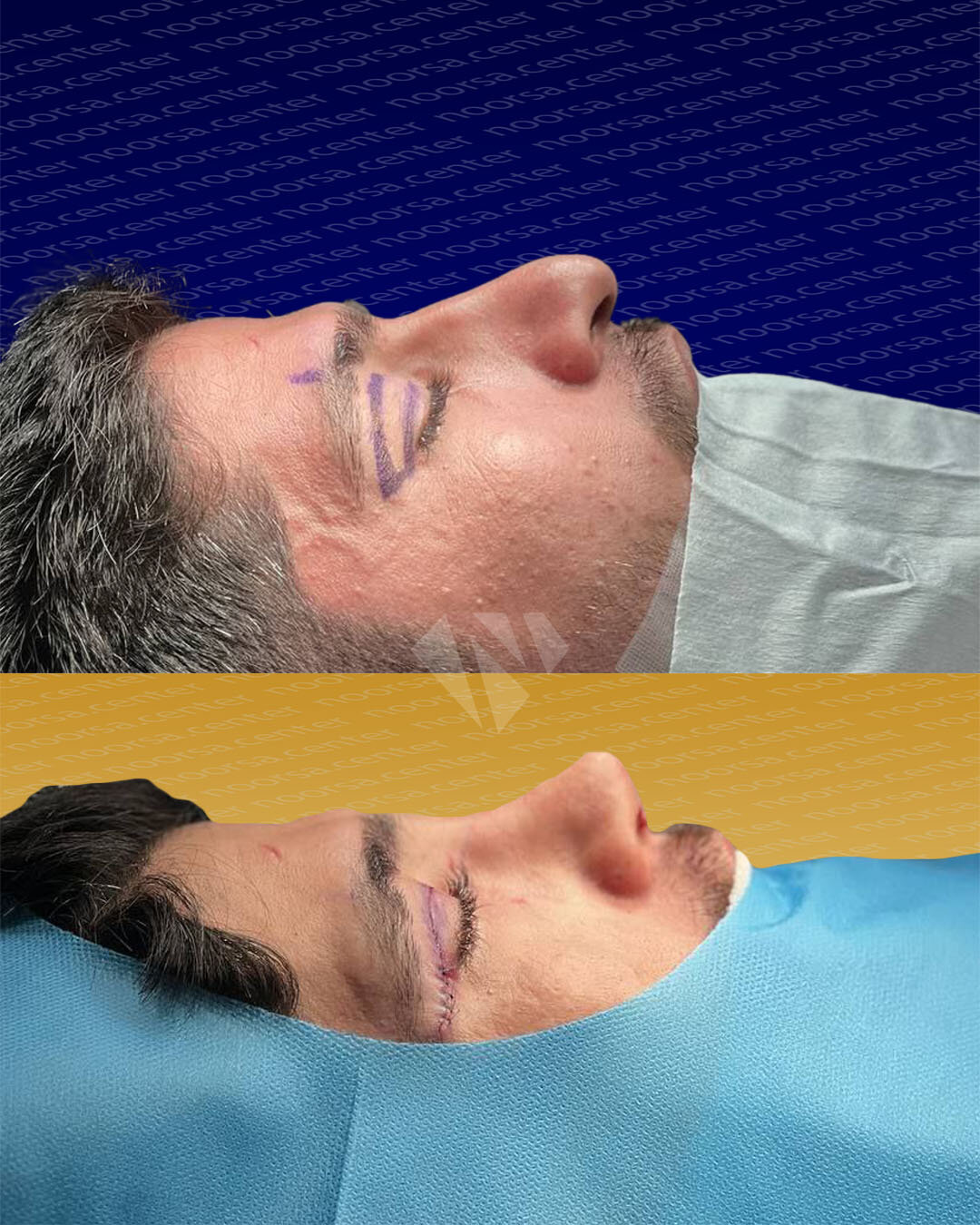 قبل و بعد از عمل بینی