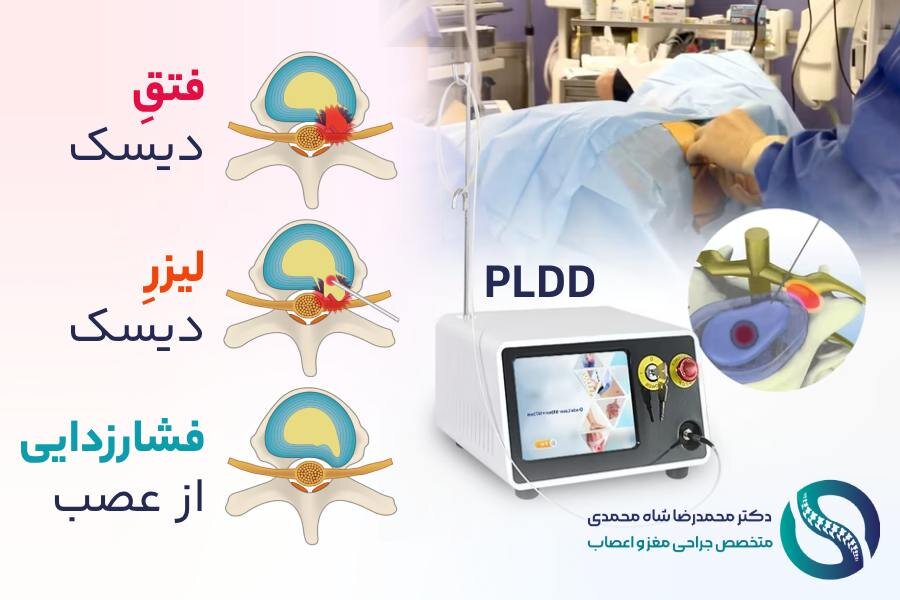 نحوه عمل لیزر دیسک کمر - دکتر محمدرضا شاه محمدی