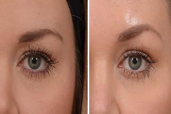 بردن ابرو با تزریق ژل