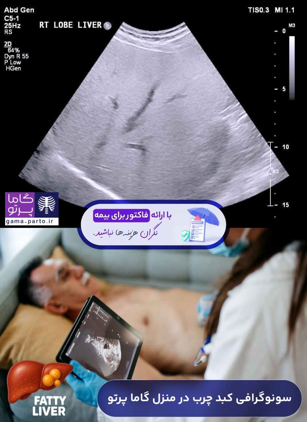 سونوگرافی کبد چرب در منزل توسط گاما پرتو (رتبه برتر سونوگرافی در منزل)