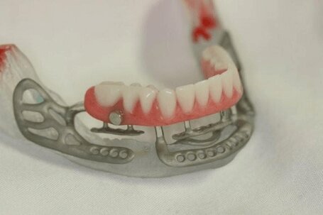 ساب پریوستئال