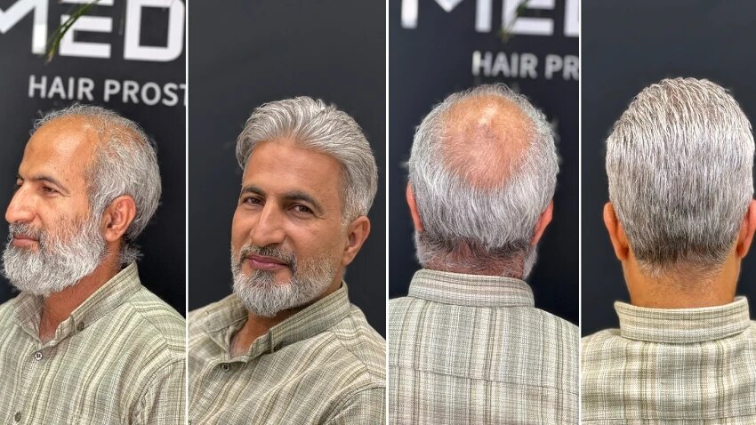 پروتز مو در مقایسه با کاشت مو؛ کدام بهتر است؟