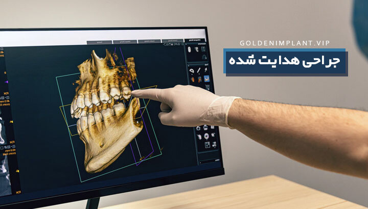 اسکن سه بعدی ایمپلنت دندان