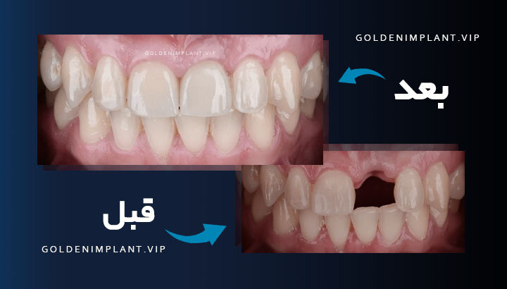 نمونه کار ایمپلنت