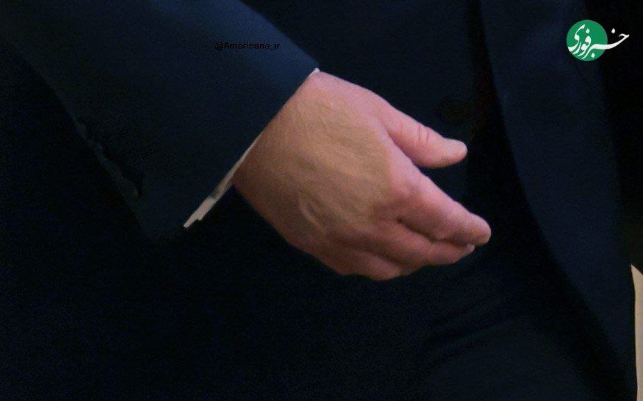 کبودی دست ترامپ