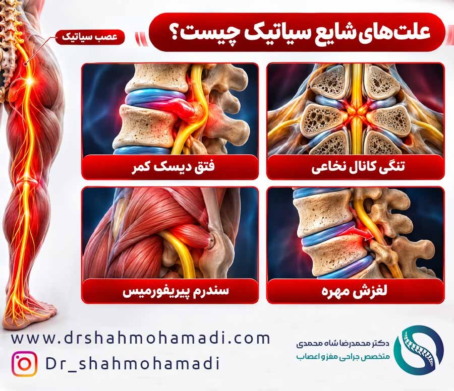 4 علت اصلی سیاتیک - دکتر محمدرضا شاه محمدی