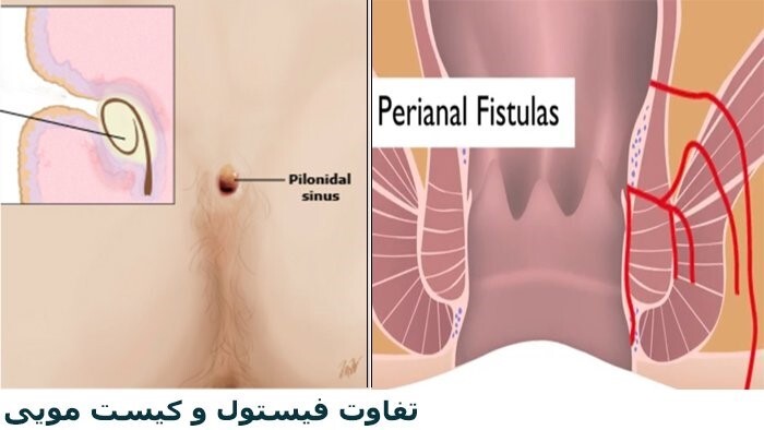 فرق کیست مویی و فیستول مقعدی چیست؟